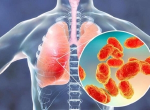 Viêm Phổi Là Gì? Tổng Quan Về Bệnh Viêm Phổi